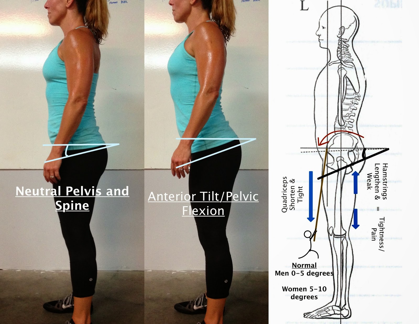 Neutral Pelvic Tilt Anterior Pelvic Tilt ACTNCI Neutral Pelvic Tilt Anterior Pelvic Tilt ACTNCI